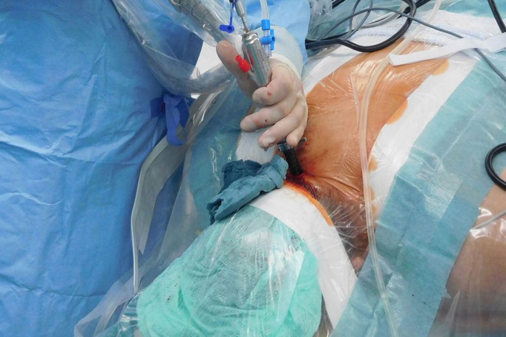 Endoscopic Cervical Surgery